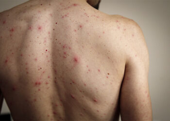 Alerta epidemiológica ante un probable caso de sarampión en localidad entrerriana 