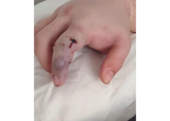 Gualeguaychú: Un joven fue mordido por una yarará y estuvo diez días internado