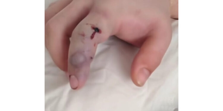 Gualeguaychú: Un joven fue mordido por una yarará y estuvo diez días internado