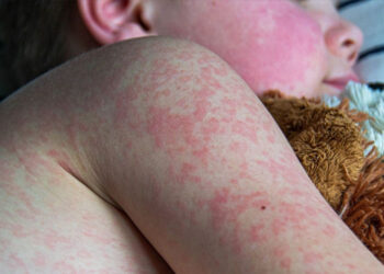 Solicitan a quienes viajaron en ómnibus por Entre Ríos estar atentos ante posible exposición al sarampión