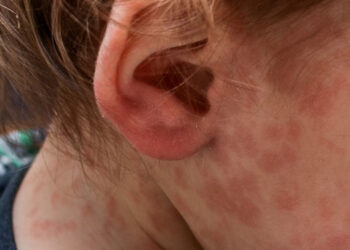 Ante la confirmación de un caso de sarampión, Salud convocó a comisión de vigilancia