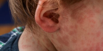 Ante la confirmación de un caso de sarampión, Salud convocó a comisión de vigilancia